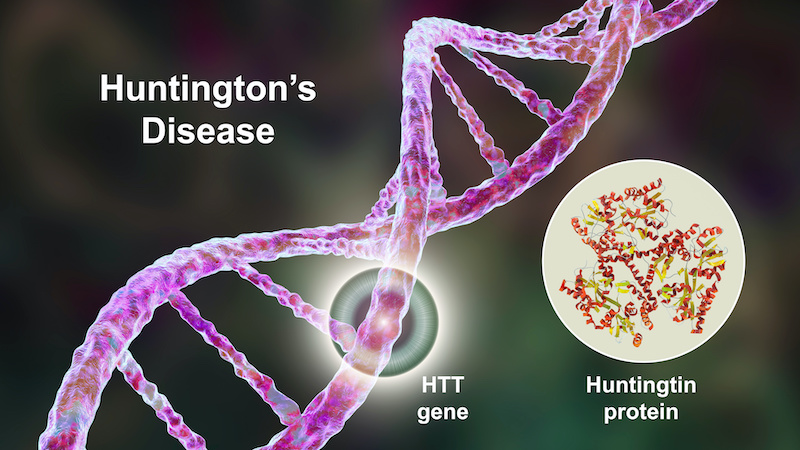 Huntington's chorea, a neurodegenerative disease due to a mutation in the huntingtin gene HTT, deficiency in the huntingtin protein and changes in brain basal ganglia, 3D illustration