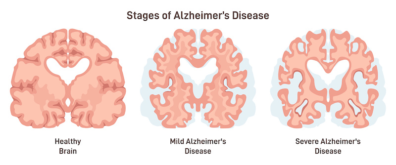 Alzheimer's disease stages. Human brain cross section, affected with progressive